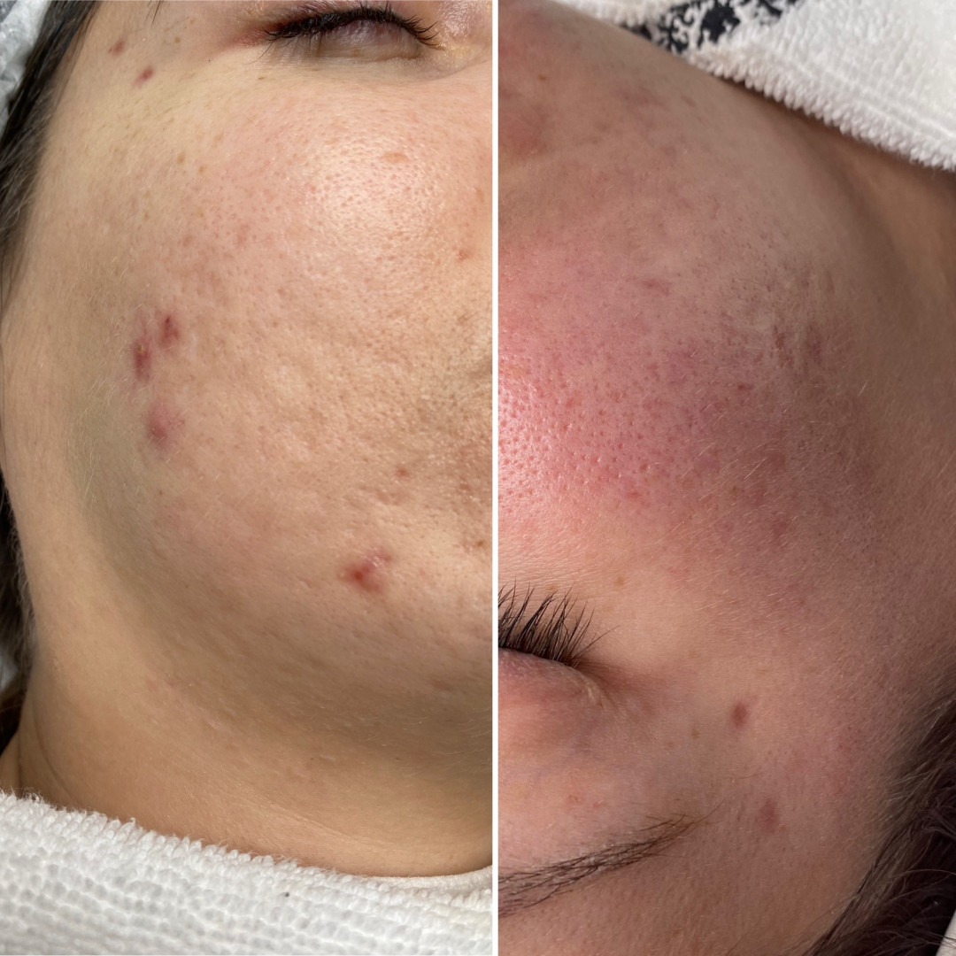 Paket tretmana za masnu kožu - Fabrika ljepote, Sarajevo Tretmani tijela Tijelo Tretmani tijela, Sarajevo, Istočno Sarajevo