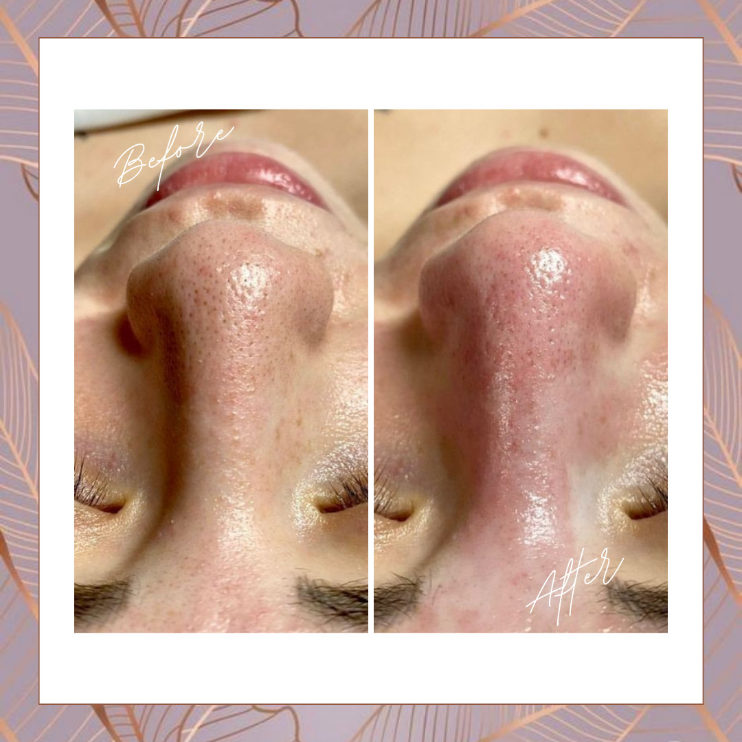 Beauty Studio Señorita #sarajevo Tretman lica Higijenski tretman čišćenja lica + Mikrodermoabrazija + Hranjenje lica - Mezoporacijom