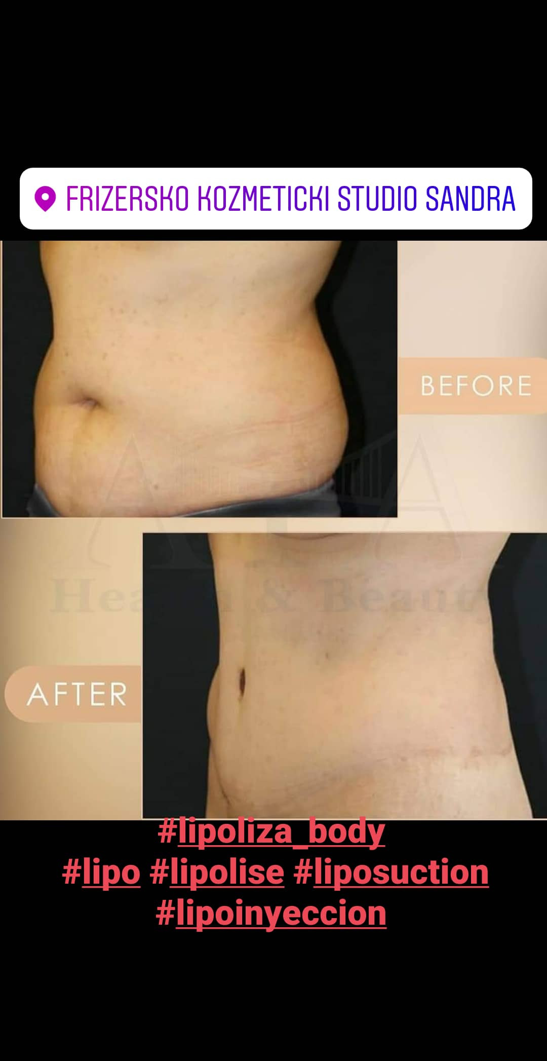 Sandra #visoko Tretman lica Lipoliza - podbradak