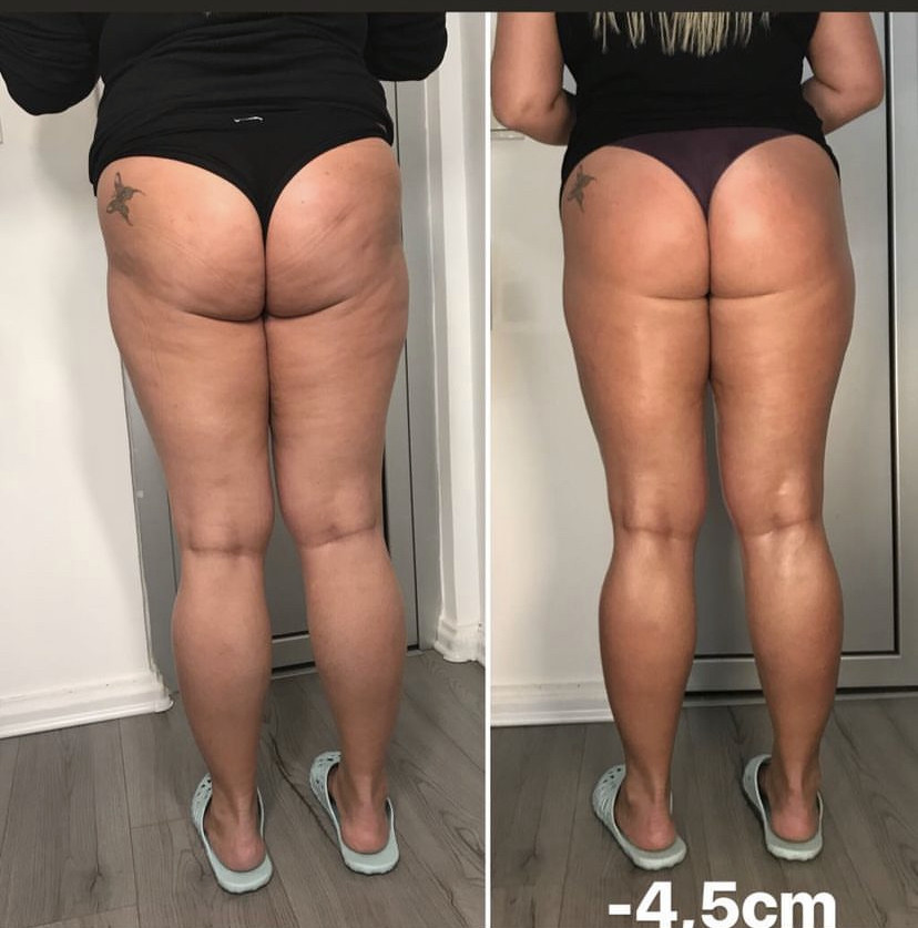 Skockica paket - maderoterapija noge + gluteus - Fabrika ljepote, Sarajevo Anticelulit masaža Masaža Anticelulit masaža, Sarajevo, Istočno Sarajevo