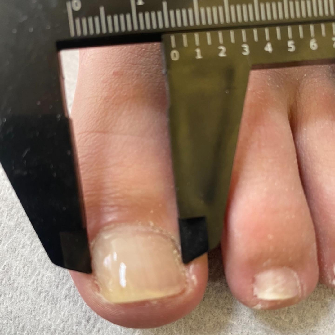 Senka #sarajevo Medicinski pedikir Obrada uraslog nokta