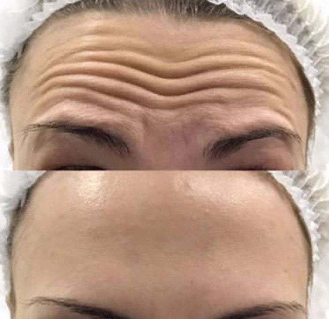 Sandra #visoko Tretman lica Biorevitalizacija lica