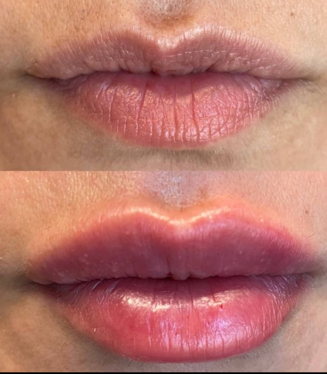 Sandra #visoko Tretman lica Biorevitalizacija lica