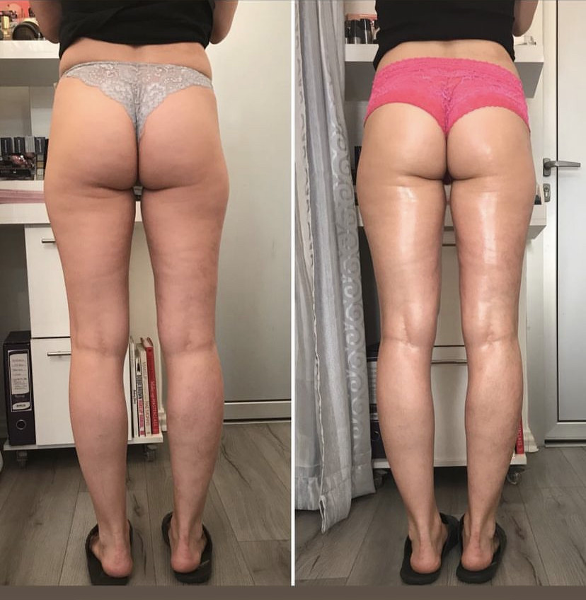 Skockica paket - maderoterapija noge + gluteus - Fabrika ljepote, Sarajevo Anticelulit masaža Masaža Anticelulit masaža, Sarajevo, Istočno Sarajevo