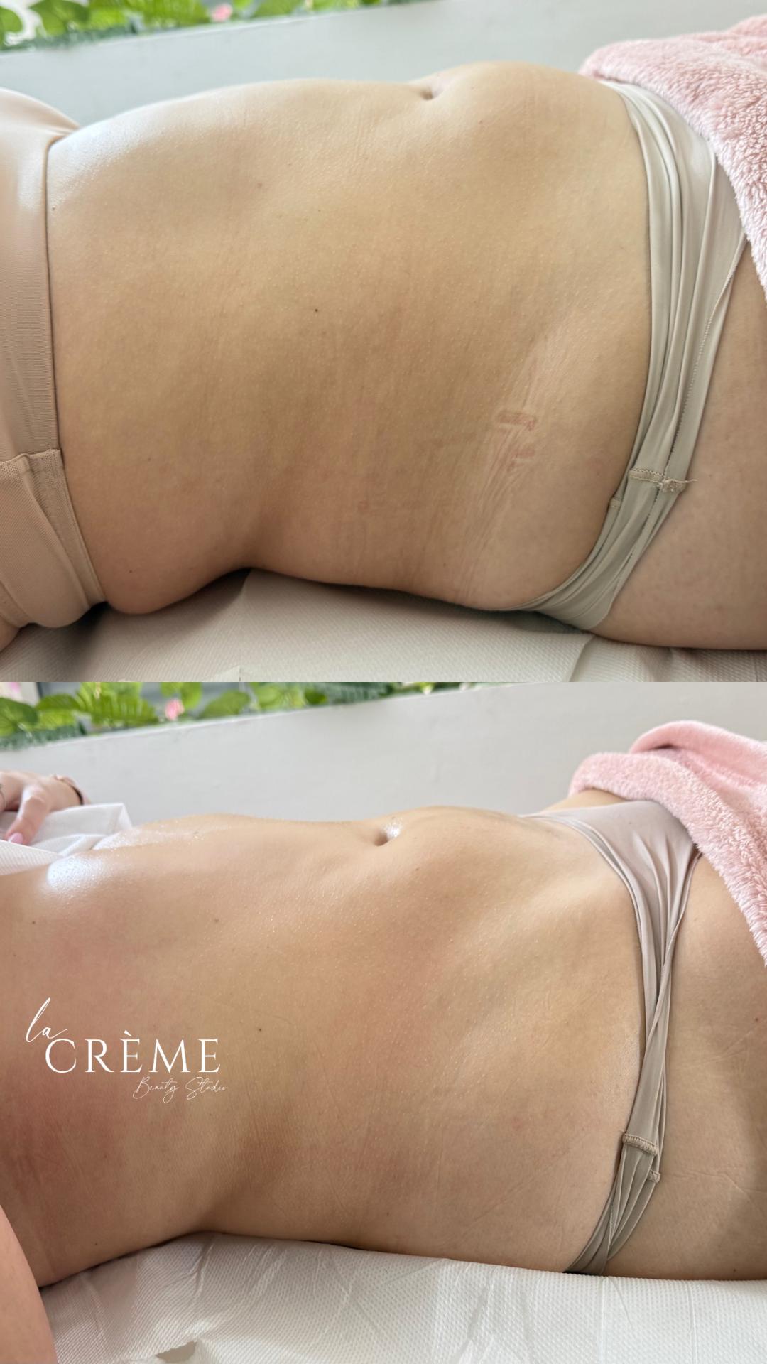 La Crème Beauty Studio #sarajevo Tretmani tijela Brazilska Limfna Drenaza - po regiji