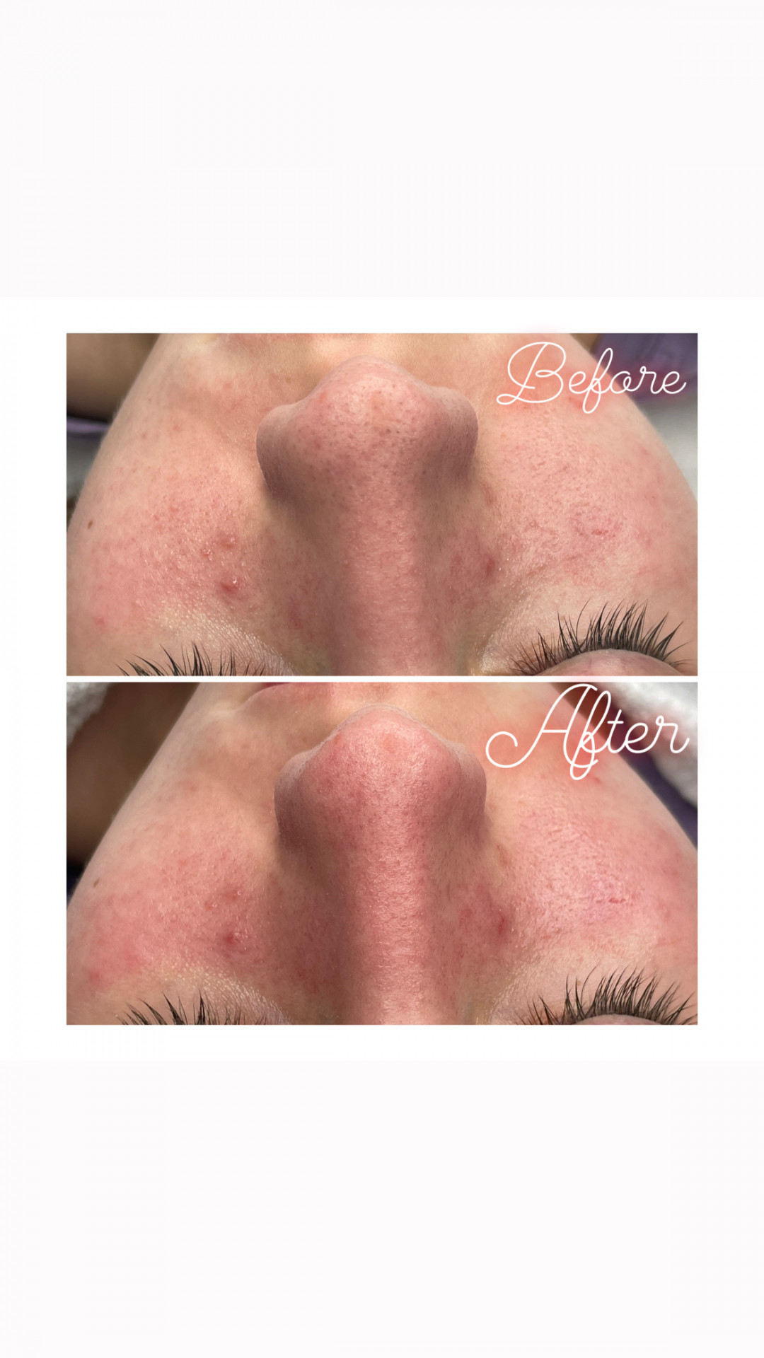 La Esthetique #sarajevo Tretman lica HydraFacial