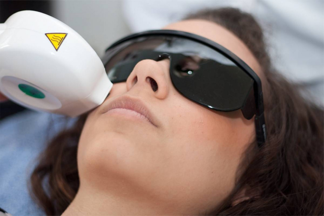 Vedrana #sarajevo Laserska epilacija