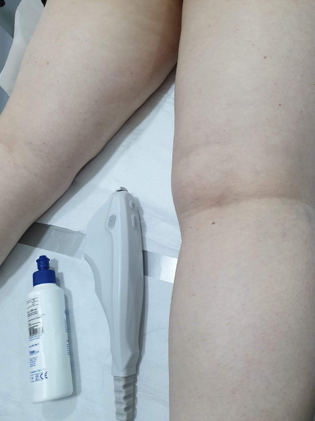 Sandra #visoko Tretmani tijela HiFU - listovi