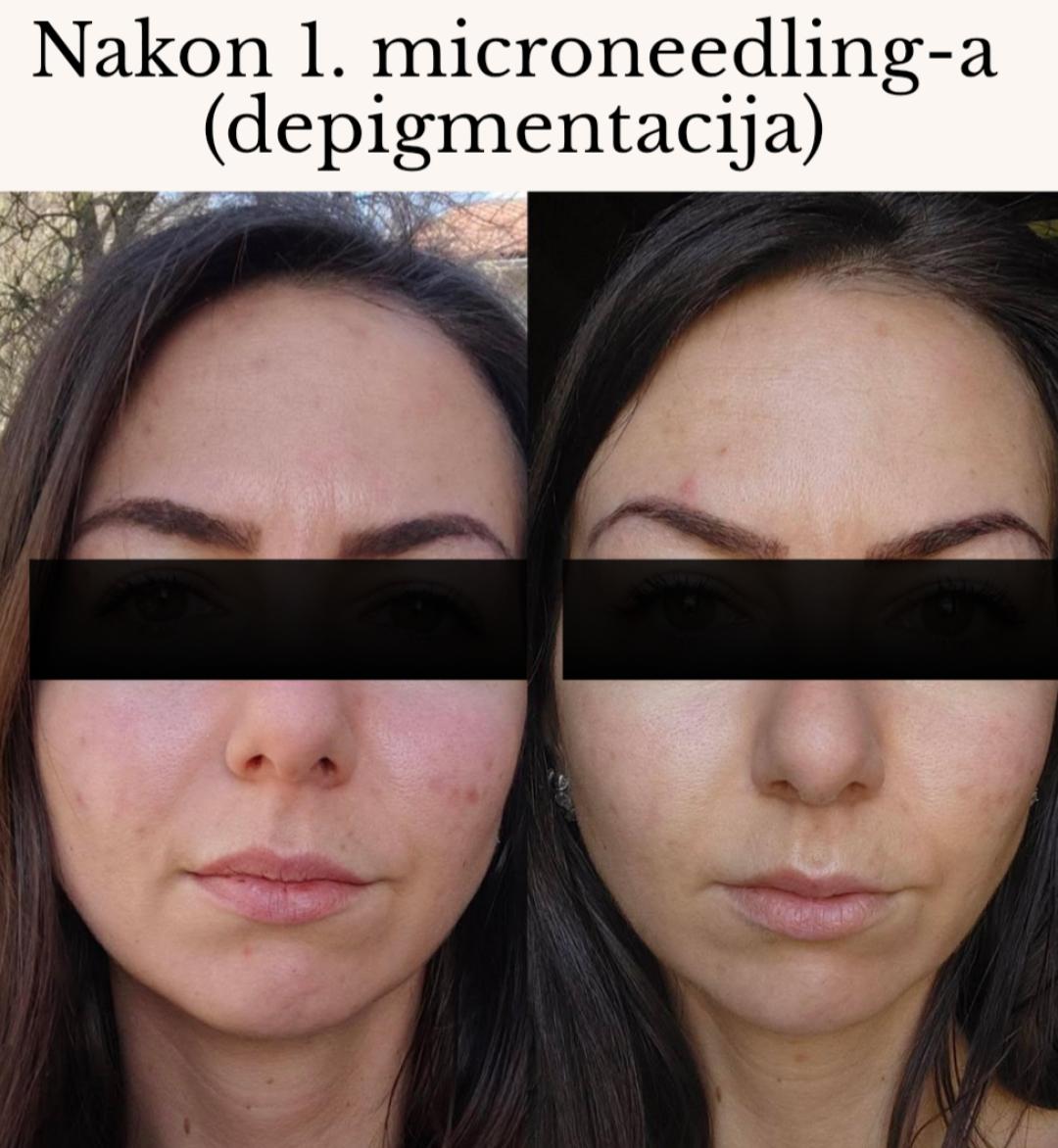 Microneedling Face - Sakina, Sarajevo Mezoterapija lica Lice Mezoterapija lica, Sarajevo, Novo Sarajevo - Novi Grad