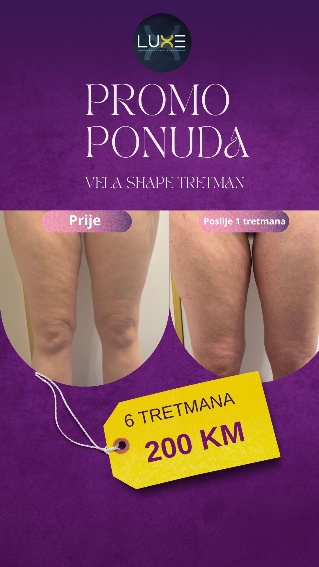 Beauty studio Luxe #sarajevo Lifting / zatezanje kože VelaShape Platinum tretman - cijelo lice