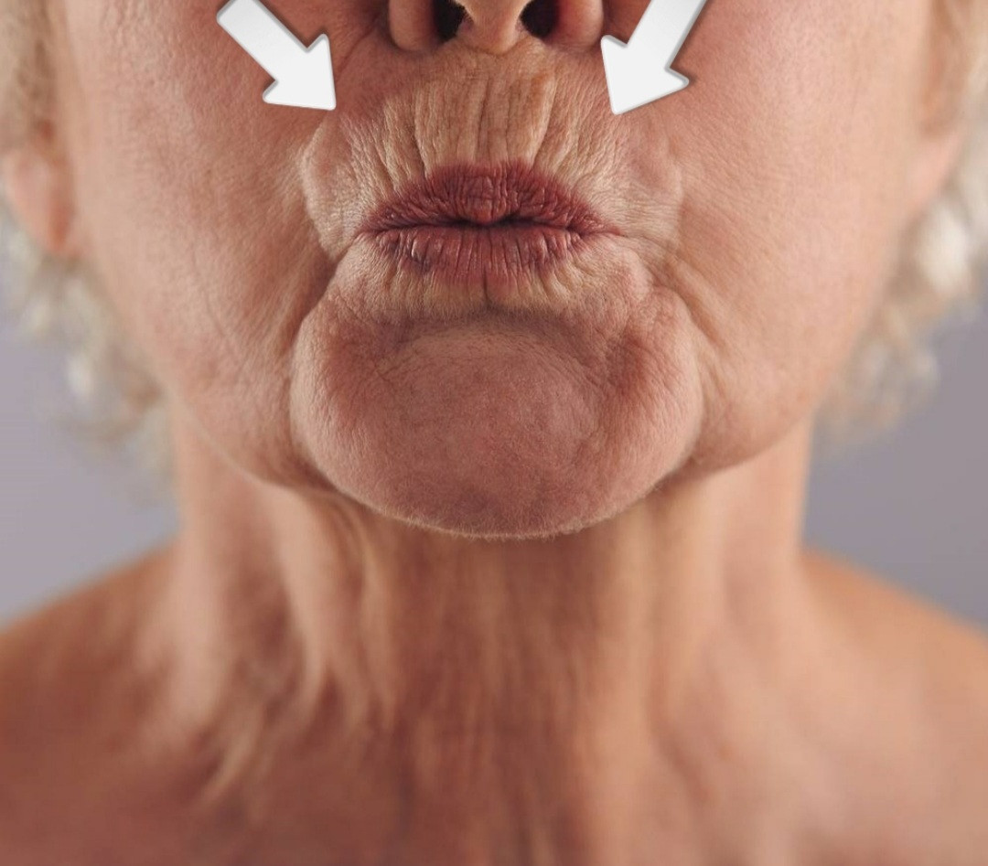 Sandra #visoko Tretman lica HIFU - cijelo lice