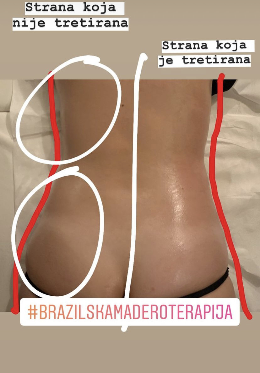 Brazilska maderoterapija paket - cijelo tijelo - Fabrika ljepote, Sarajevo Anticelulit masaža Masaža Anticelulit masaža, Sarajevo, Istočno Sarajevo