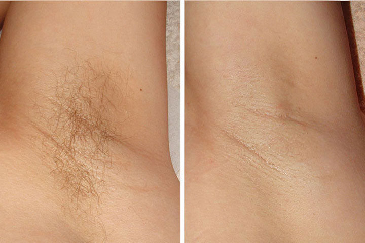 Ayana Spa #sarajevo Depilacija šećernom pastom Depilacija pazuha šećernom pastom - za dame