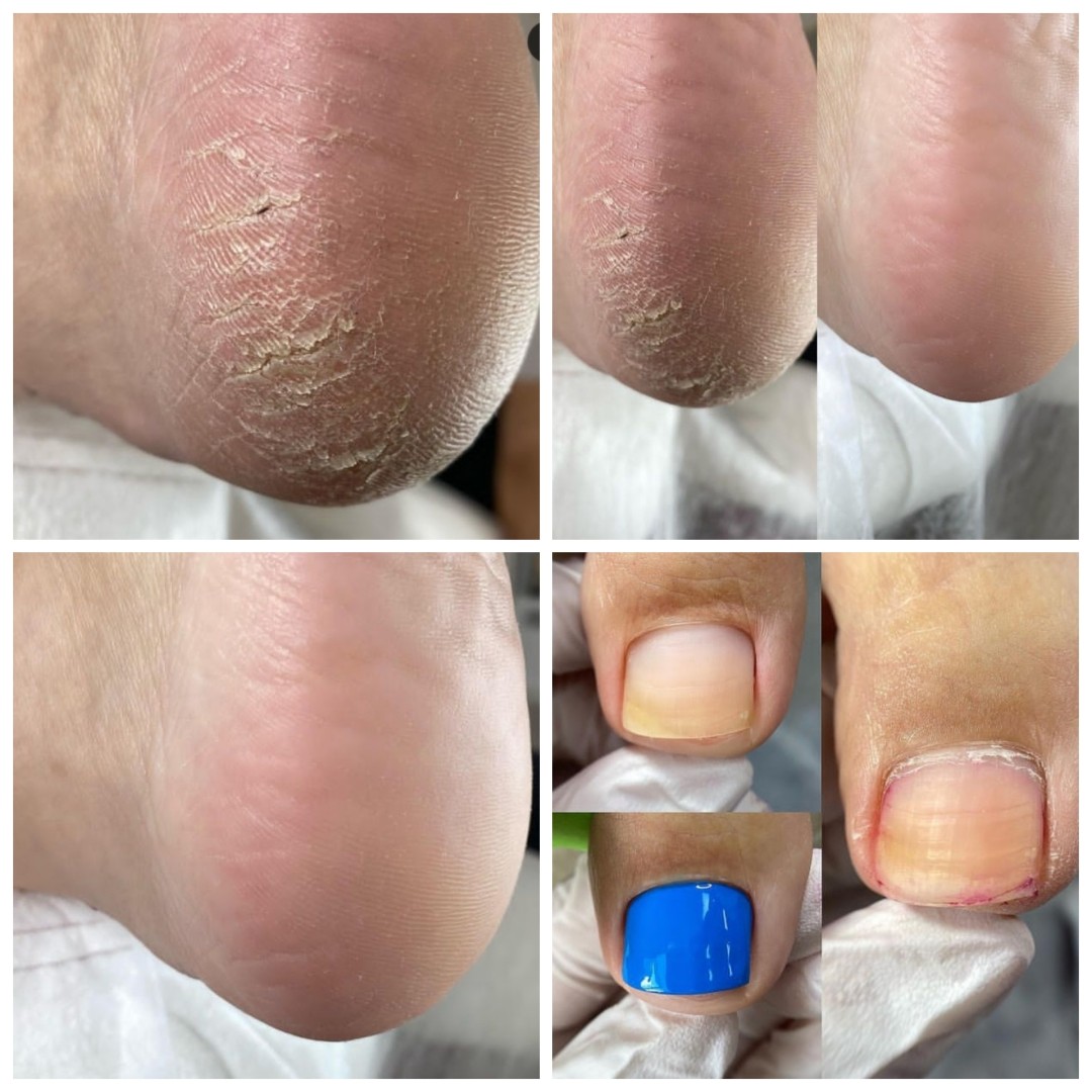 Poezija ljepote #sarajevo Estetski pedikir Klasična pedikura + trajni lak