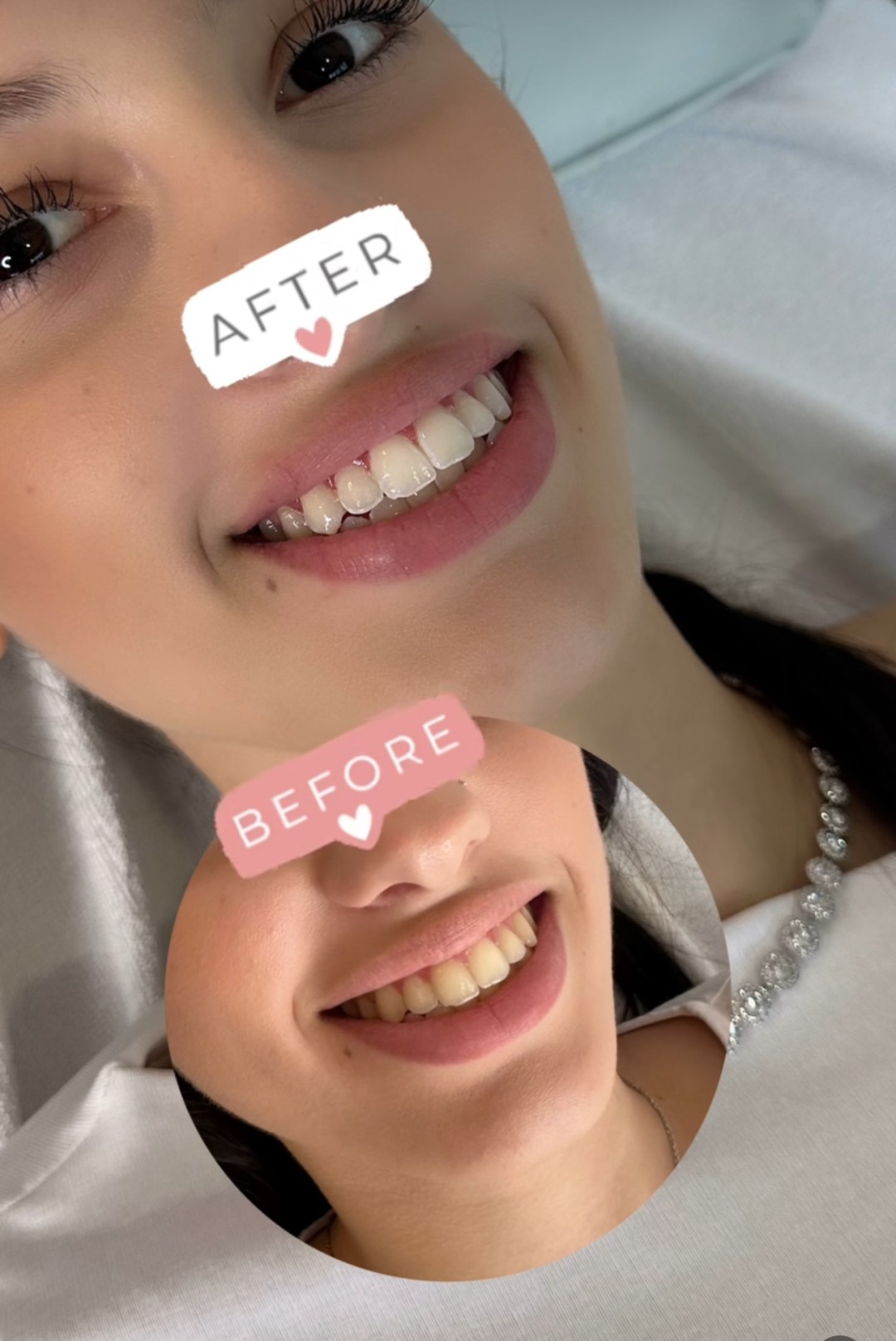 Izbjeljivanje zuba - Perfect Smile, izbjeljivanje zuba Cazin, Cazin Zubi Wellness Zubi, Cazin, Centar