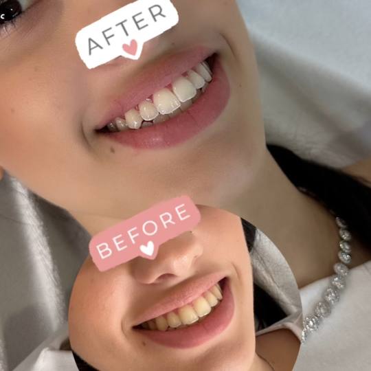 Perfect Smile, izbjeljivanje zuba Cazin usluga