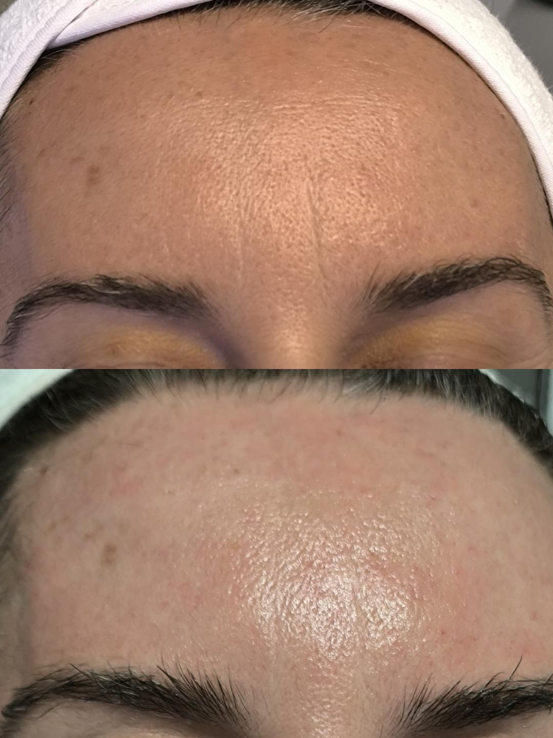 Paket Lumielle Glow- hemijski piling+mezoterapija lica - Estetika Janković, Banja Luka Piling lica Lice Piling lica, Banja Luka, Centar