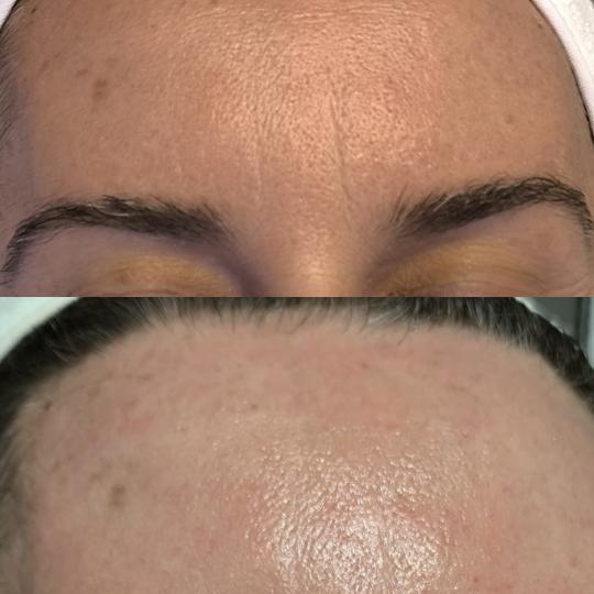 Estetika Janković #banjaluka Piling lica Paket Lumielle Glow- hemijski piling+mezoterapija lica Kom