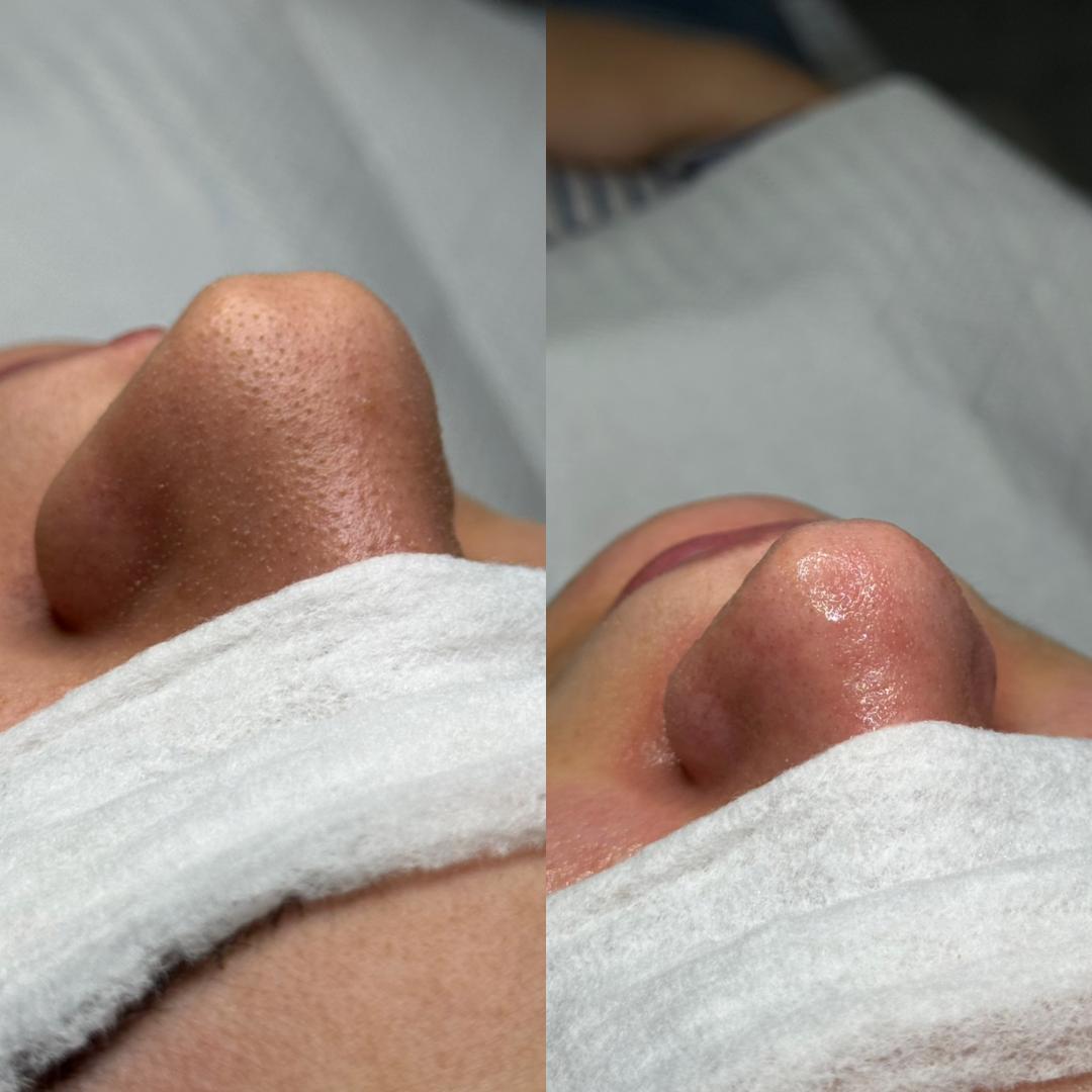 Hanas Skin Centar #banjaluka Air brush potamnjivanje kože Klasično higijensko čišćenje lica