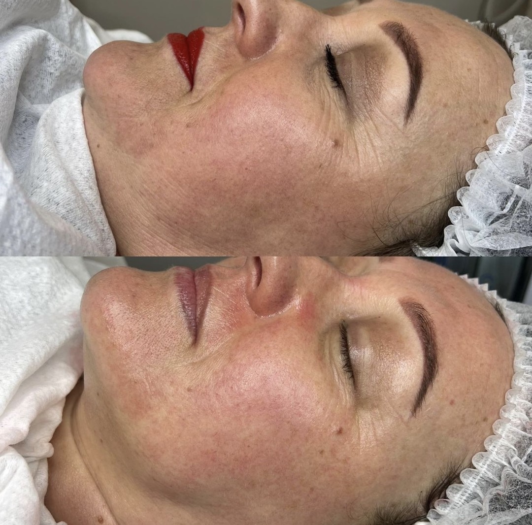 Dora Beauty #sarajevo Tretmani protiv bora Antiage tretman lica