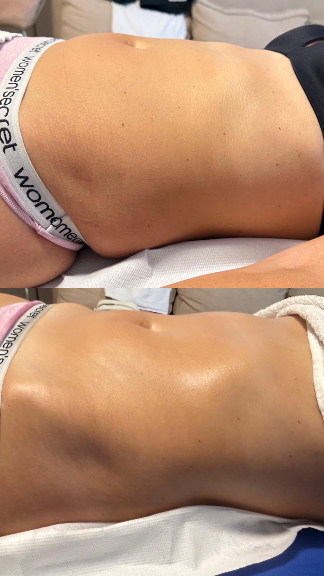 La Crème Beauty Studio #sarajevo Tretmani tijela Brazilska Limfna Drenaza - po regiji