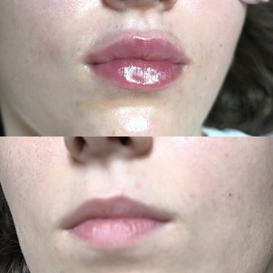 Estetika Janković #banjaluka Tretman lica Hijaluronski filer - 1 ml korekcija usana hijaluronom