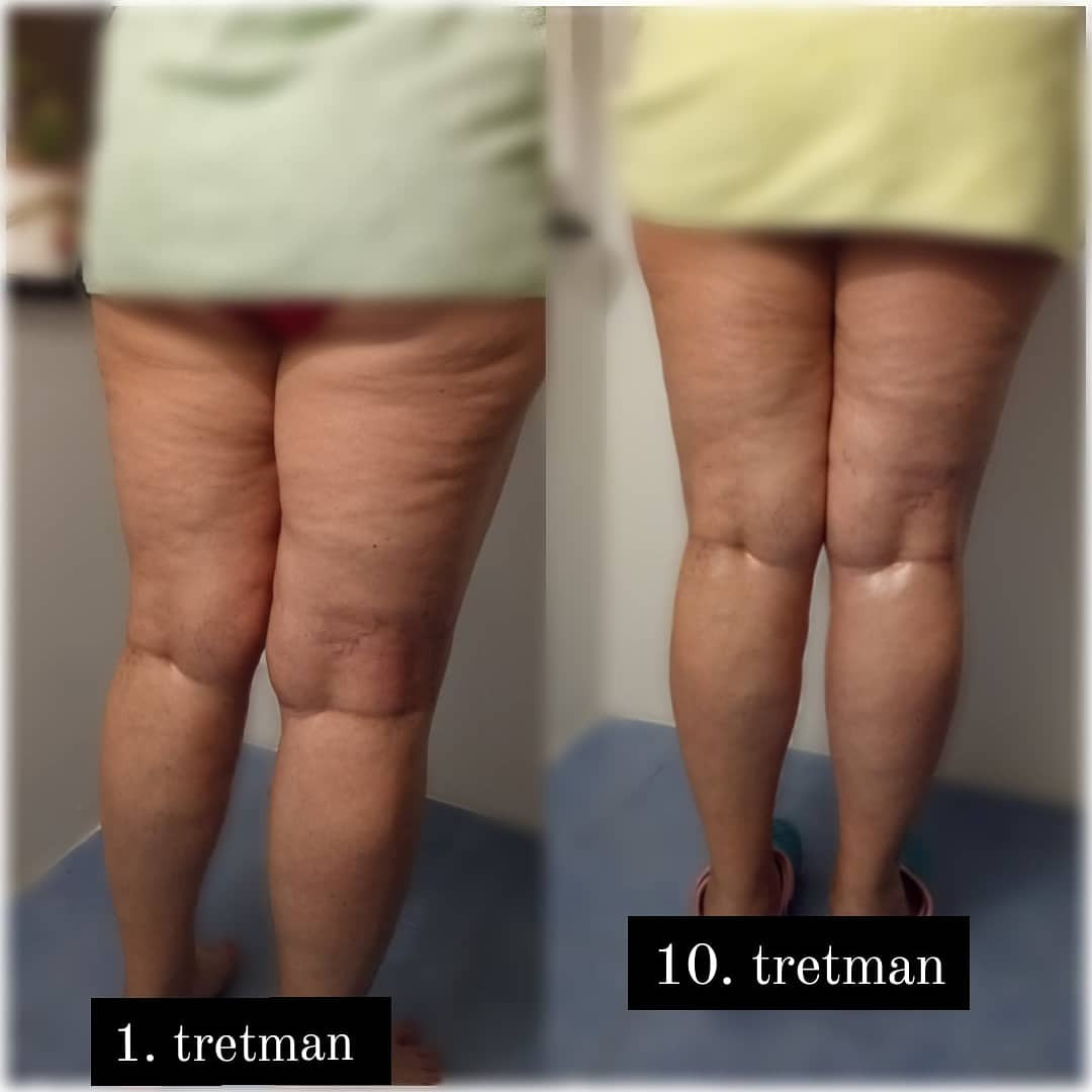 Nervus #banjaluka Anticelulit masaža Anticelulit masaža