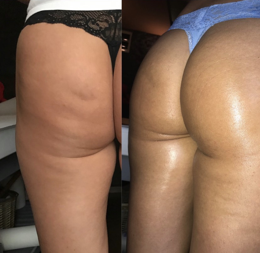 Combo S paket - maderoterapija noge + gluteus - Fabrika ljepote, Sarajevo Anticelulit masaža Masaža Anticelulit masaža, Sarajevo, Istočno Sarajevo