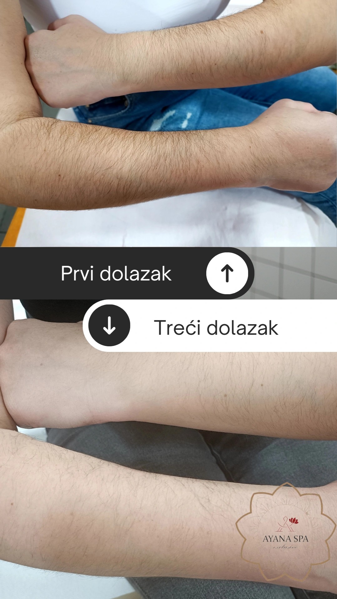 Ayana Spa #sarajevo Depilacija šećernom pastom Depilacija cijelih ruku šećernom pastom - za dame