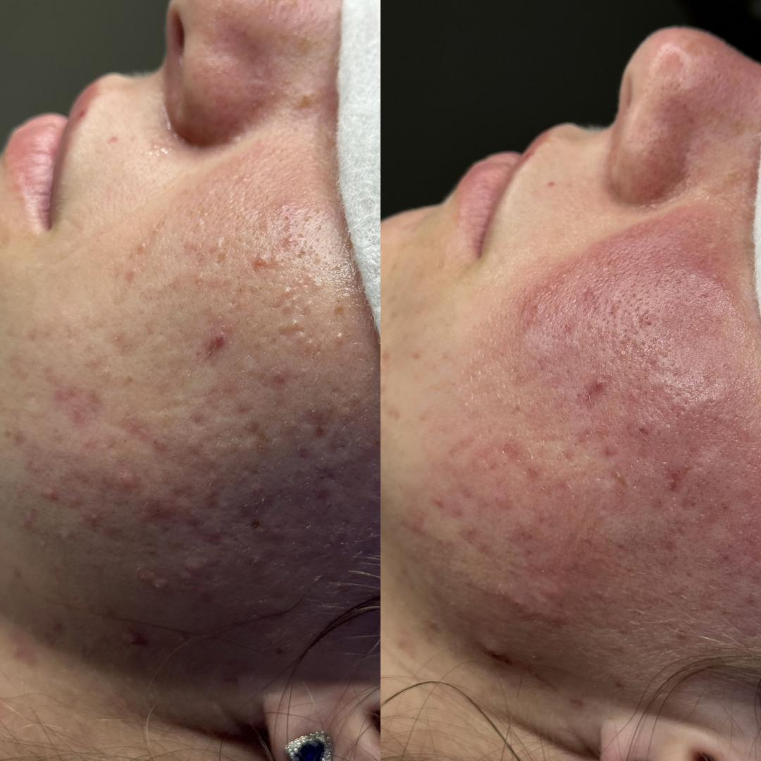 Hanas Skin Centar #banjaluka Air brush potamnjivanje kože Klasično higijensko čišćenje lica