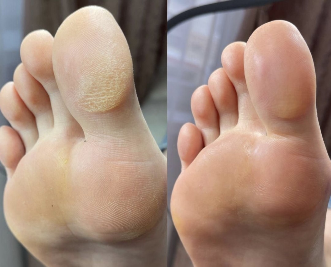 Nail Queen #sarajevo Estetski pedikir Ruski pedikir