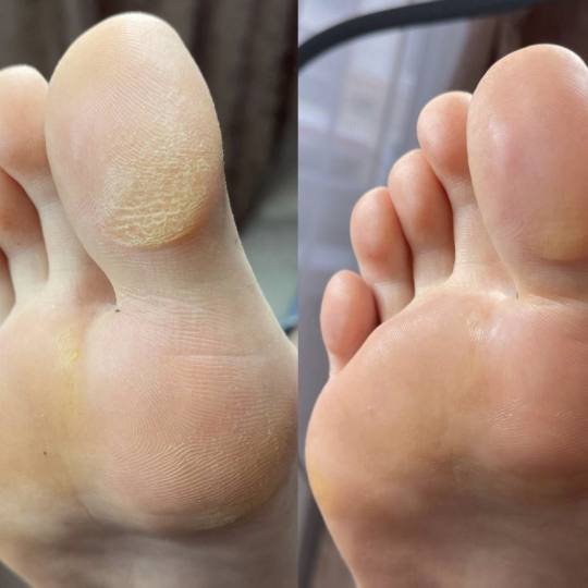 Nail Queen #sarajevo Estetski pedikir Ruski pedikir