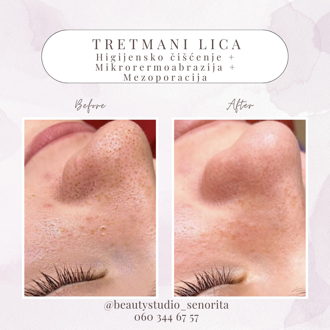 Beauty Studio Señorita #sarajevo Tretman lica Higijenski tretman čišćenja lica + Mikrodermoabrazija + Hranjenje lica - Mezoporacijom