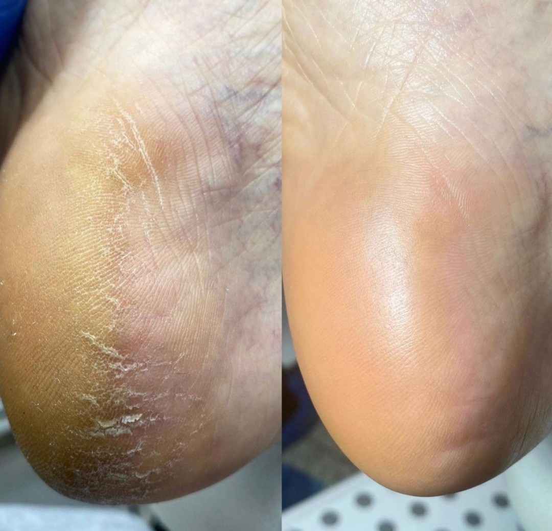 Poezija ljepote #sarajevo Estetski pedikir Ruska pedikura - bez laka