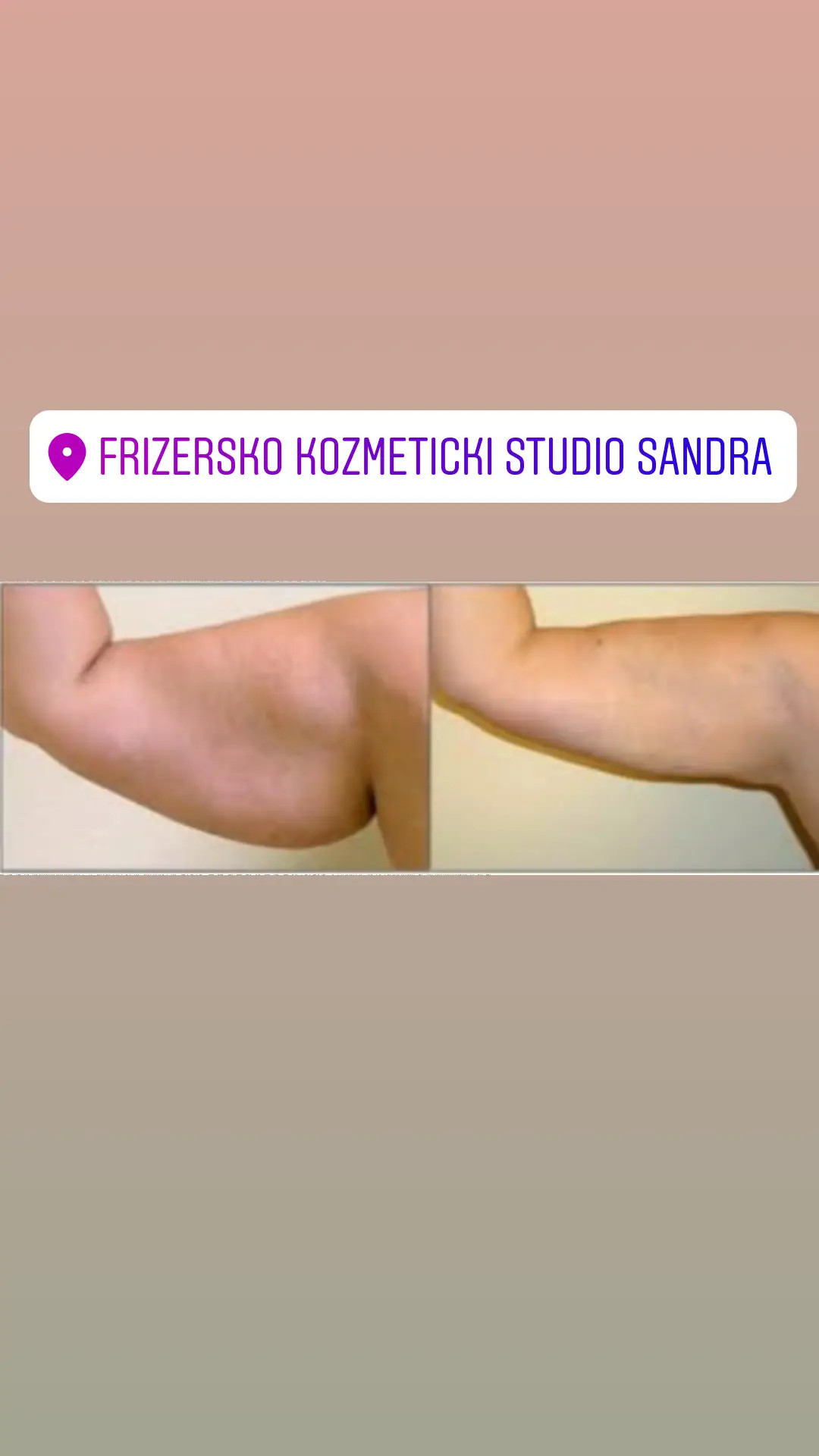 Sandra #visoko Tretmani tijela HIFU - ruke