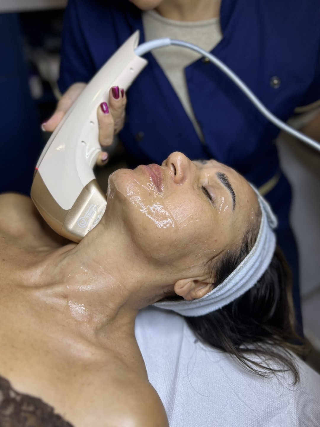 Angels Beauty - Banja Luka #banjaluka Tretman lica HIFU tretman - čelo + oči + obrazi