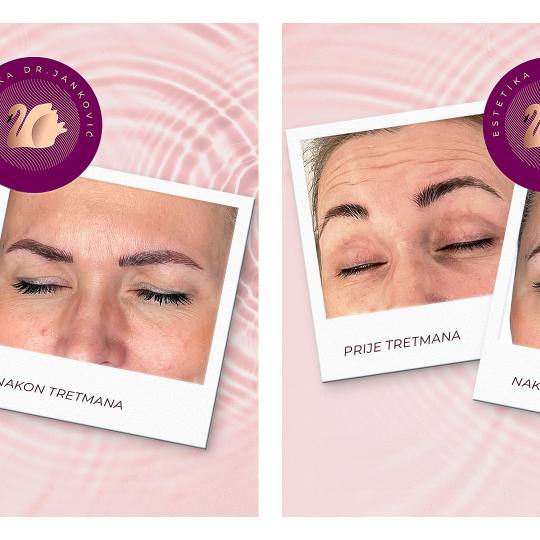 Estetika Janković #banjaluka botoks