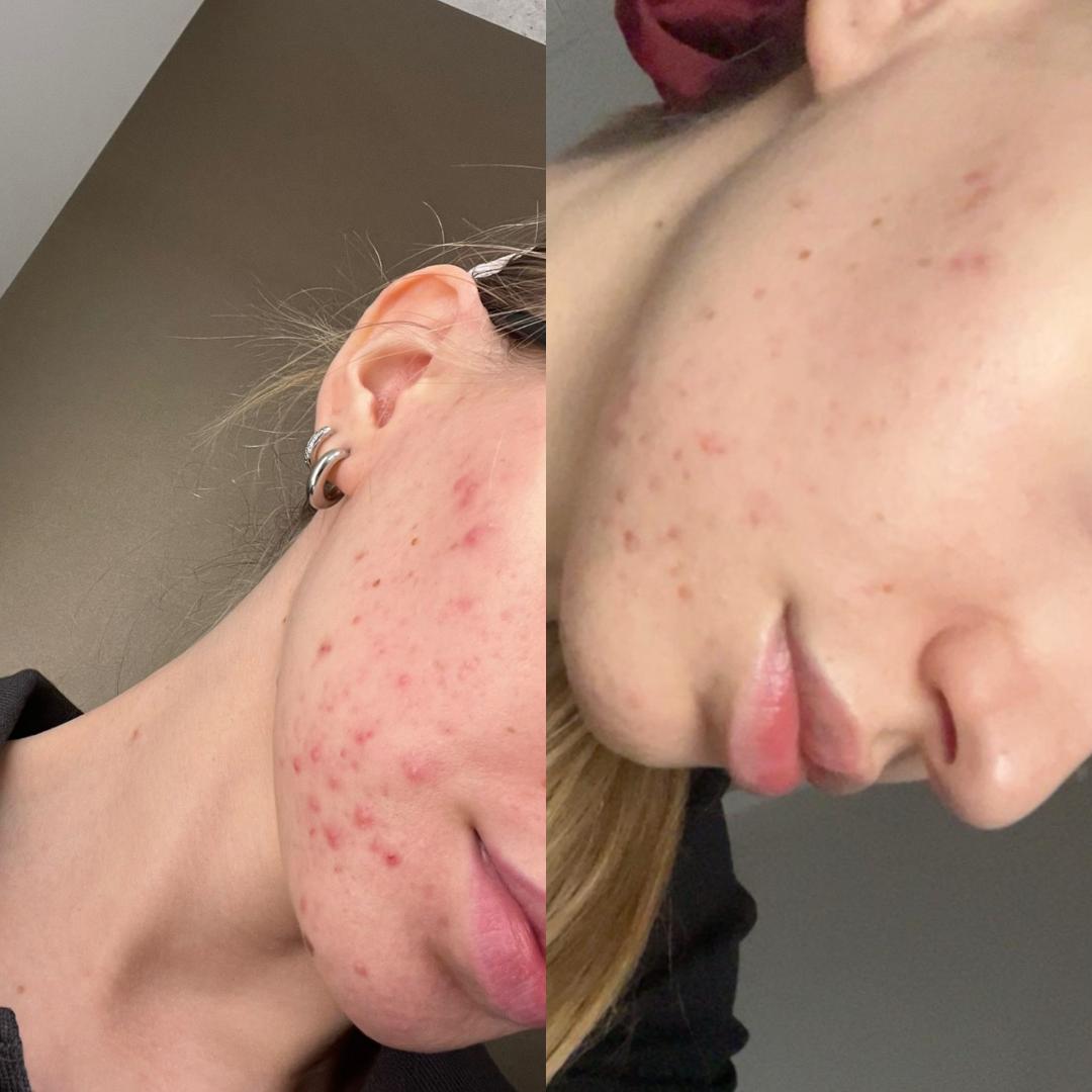 Microneedling tretman protiv ožiljaka od akni - Hanas Skin Centar, Banja Luka Tretman lica Lice Tretman lica, Banja Luka, Centar