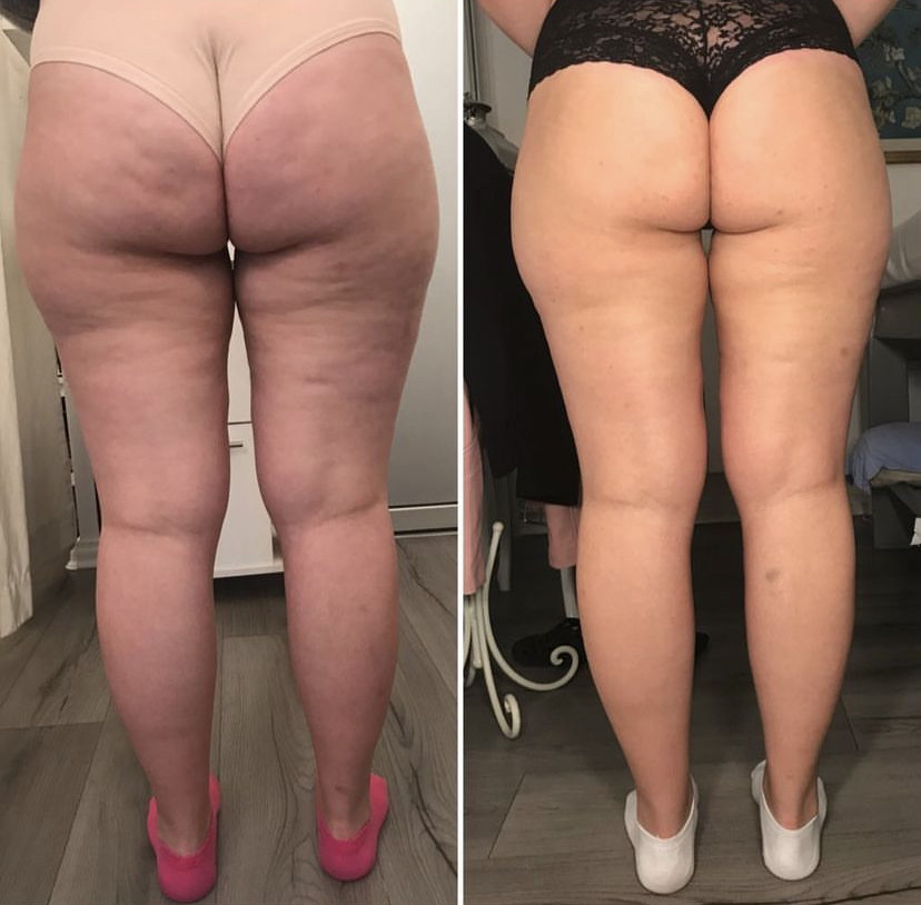 Skockica paket - maderoterapija cijelo tijelo - Fabrika ljepote, Sarajevo Anticelulit masaža Masaža Anticelulit masaža, Sarajevo, Istočno Sarajevo