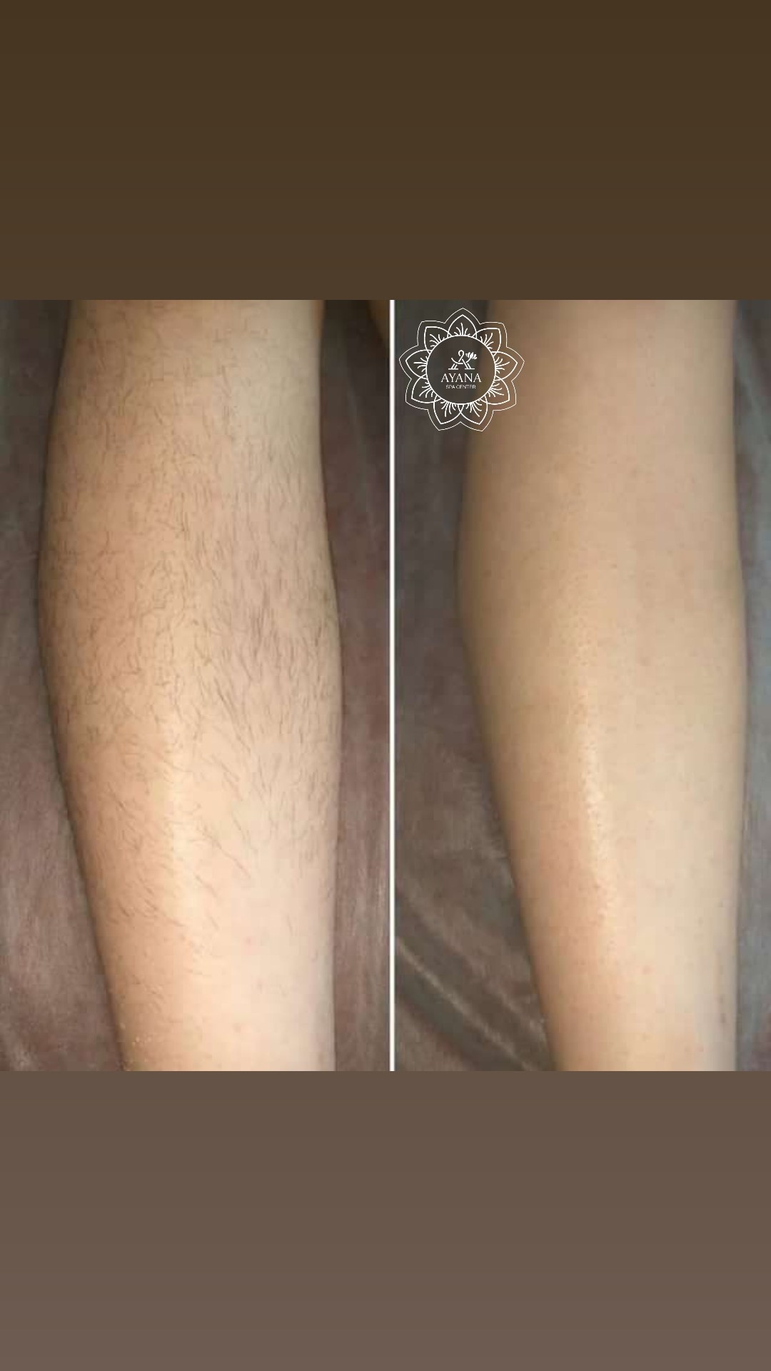 Ayana Spa #sarajevo Depilacija šećernom pastom Depilacija pola nogu šećernom pastom - za dame