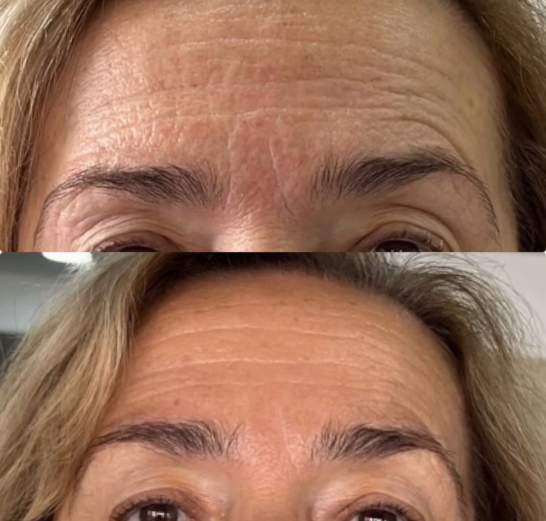 VelaShape #sarajevo Tretman lica RF tretman - lice + vrata