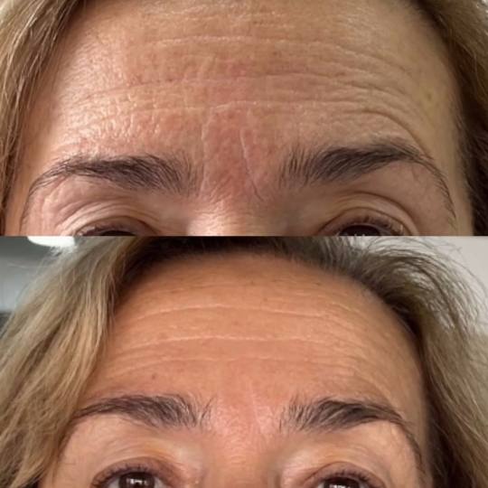 VelaShape #sarajevo Tretman lica RF tretman - lice + vrata Radiofrekvencija lica je neinvazivan tret