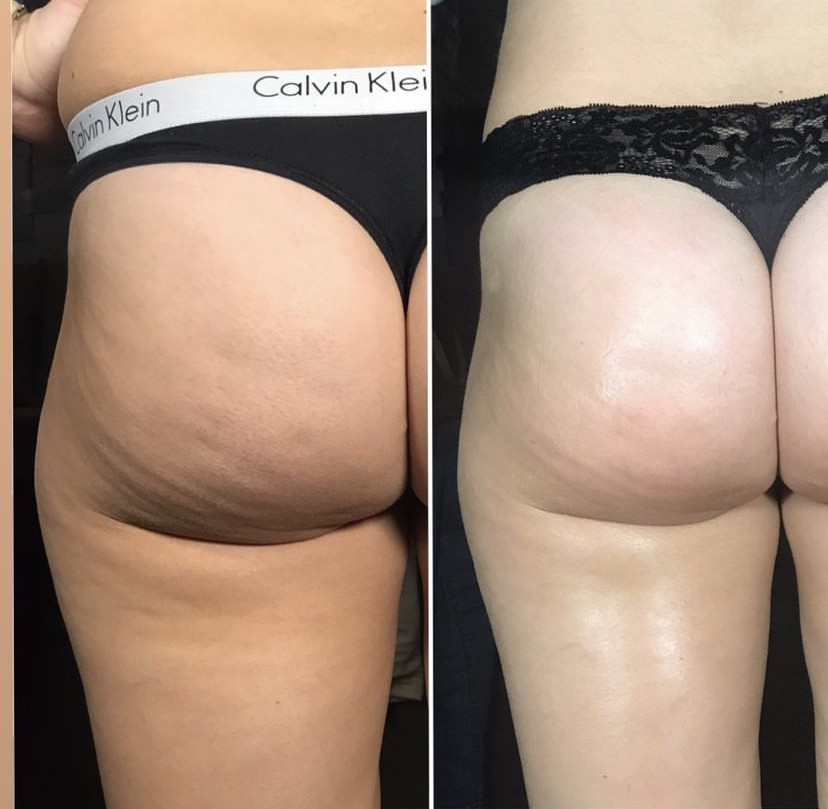 Skockica paket - maderoterapija cijelo tijelo - Fabrika ljepote, Sarajevo Anticelulit masaža Masaža Anticelulit masaža, Sarajevo, Istočno Sarajevo