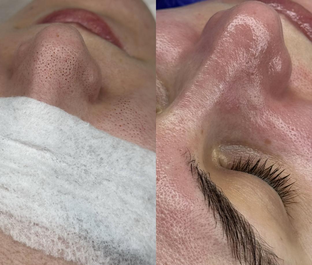 Hanas Skin Centar #banjaluka Air brush potamnjivanje kože Klasično higijensko čišćenje lica