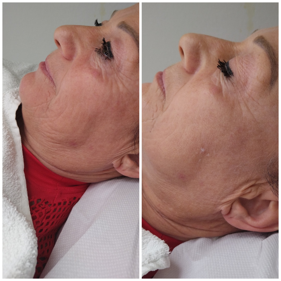 Beauty Studio Maida #tuzla Tretman lica Dermapen - hijaluronska kiselina