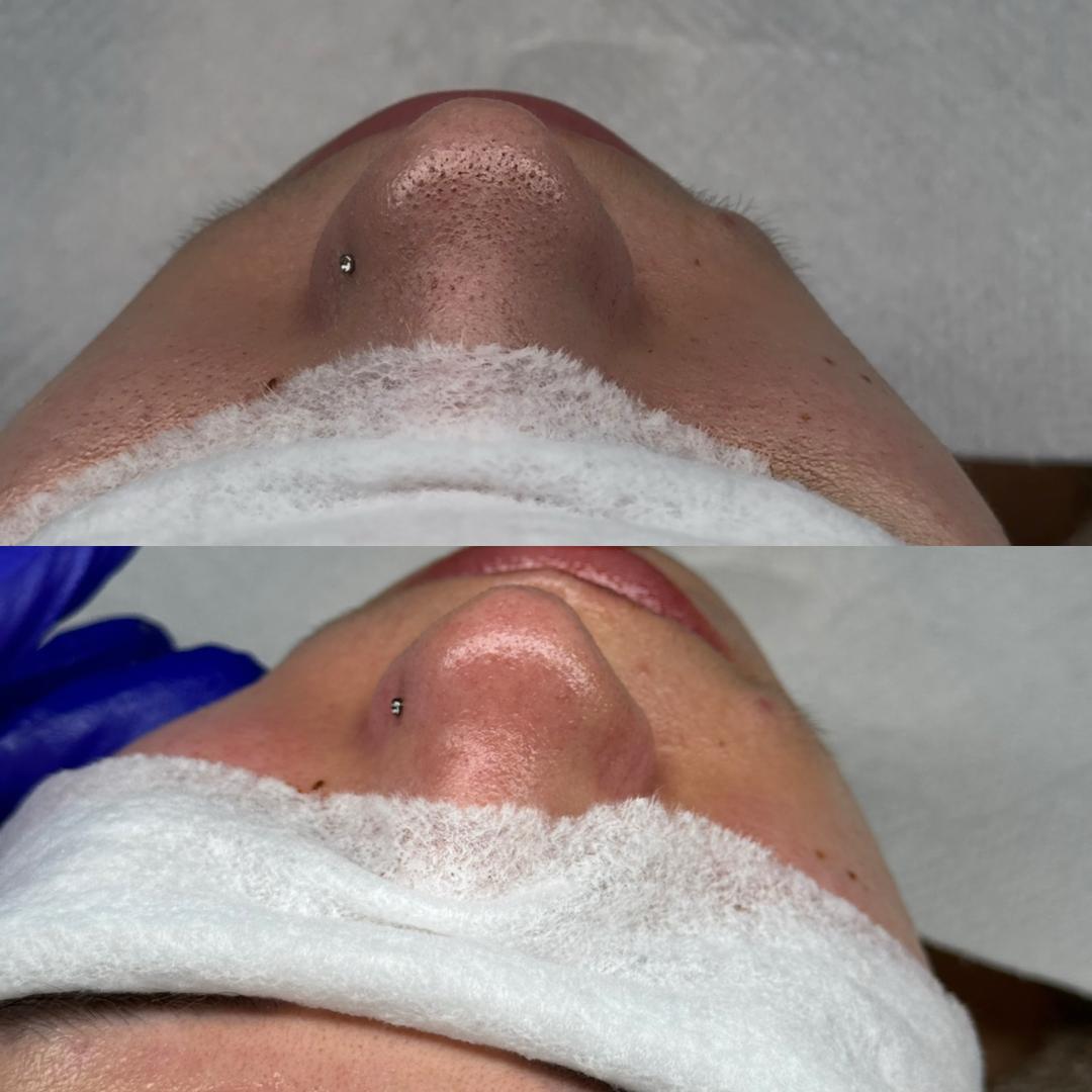 Hanas Skin Centar #banjaluka Air brush potamnjivanje kože Klasično higijensko čišćenje lica