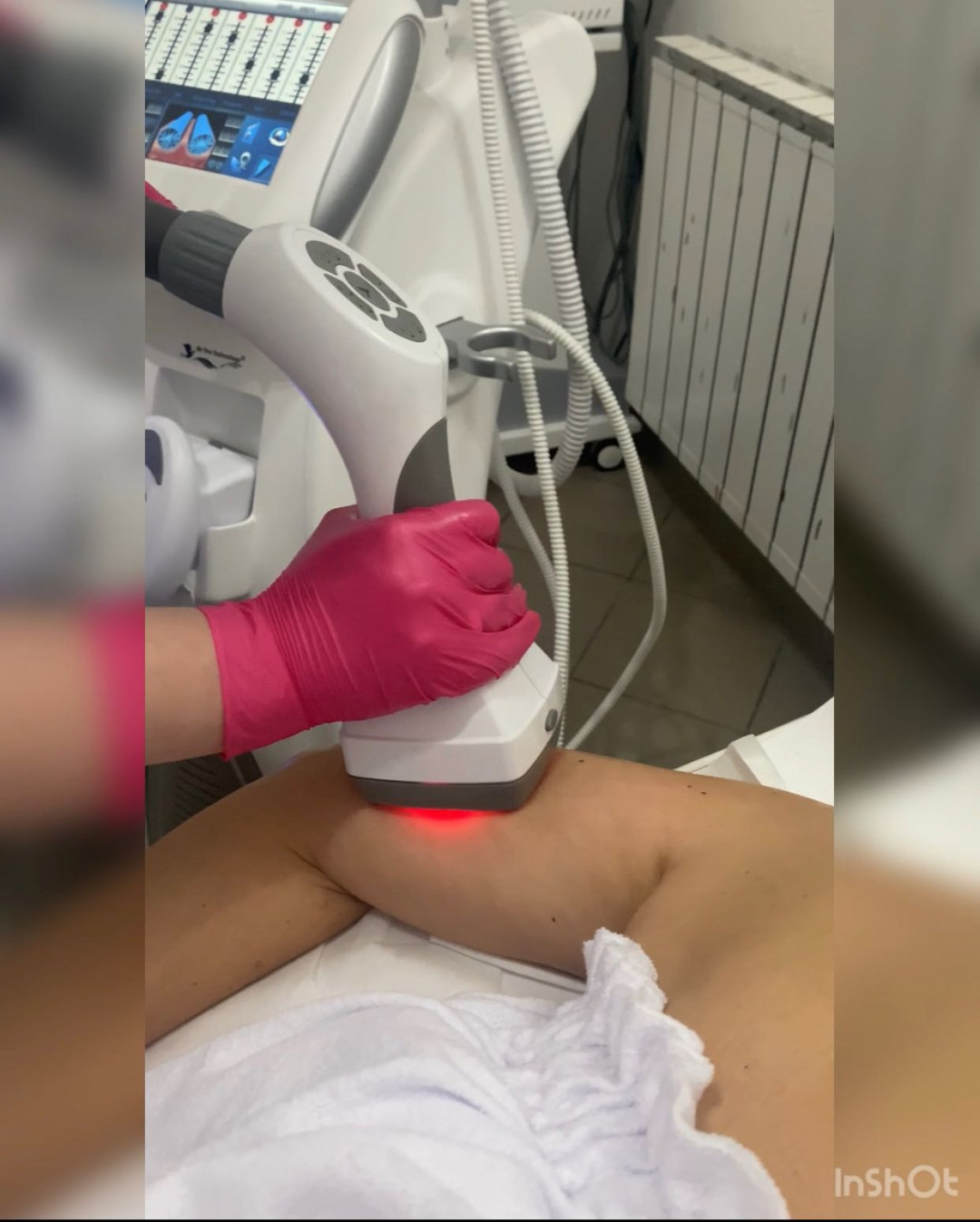 Laser Beauty Studio #visoko Tretman lica Zatezanje kože i redukcija masnih naslaga - ruke