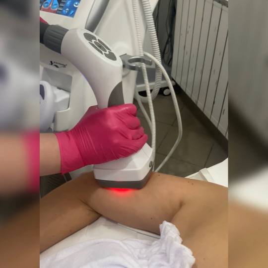 Laser Beauty Studio #visoko Tretman lica Zatezanje kože i redukcija masnih naslaga - ruke