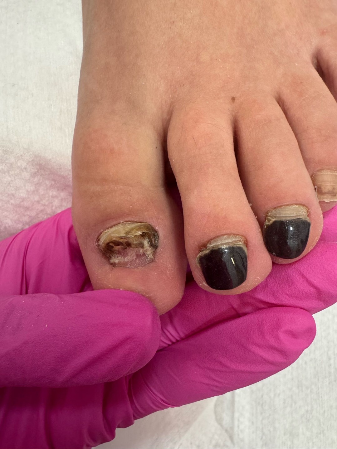 Fridem #banjaluka Medicinski pedikir Medicinski pedikir - oboljenje jednog nokta