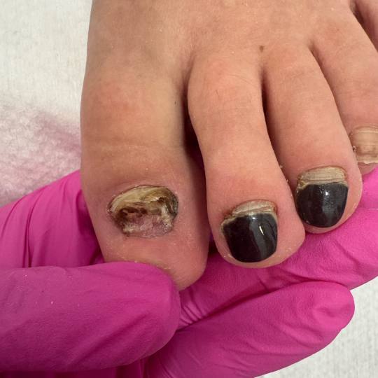 Fridem #banjaluka Medicinski pedikir Medicinski pedikir - oboljenje jednog nokta